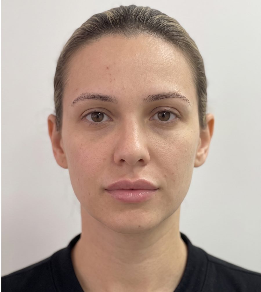Paciente fictícia (imagem gerada por IA) após o procedimento labial, rosto frontal inteiro